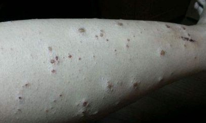 疥疮是由疥虫引起的传染性皮肤病,患了疥疮必须及时就医,治疗时必须