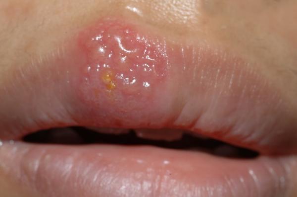 口唇疱疹常在口唇黏膜处出现针头大小的小疱,常为一群,也有两三群